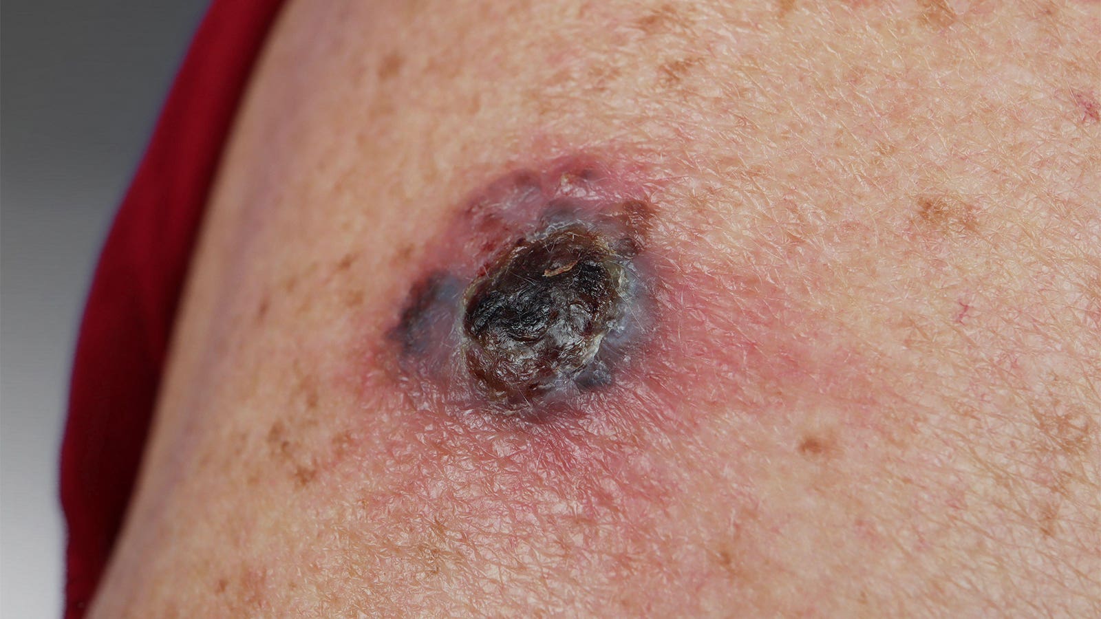 FDA staff unconvinced drug for melanoma shows benefit