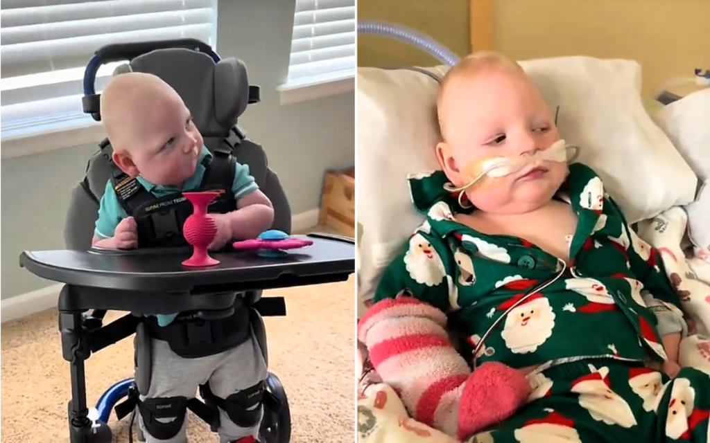 Merritt suffers from microcephaly with a simplified gyral pattern, cerebral palsy, epilepsy, CVI, and hearing loss.
