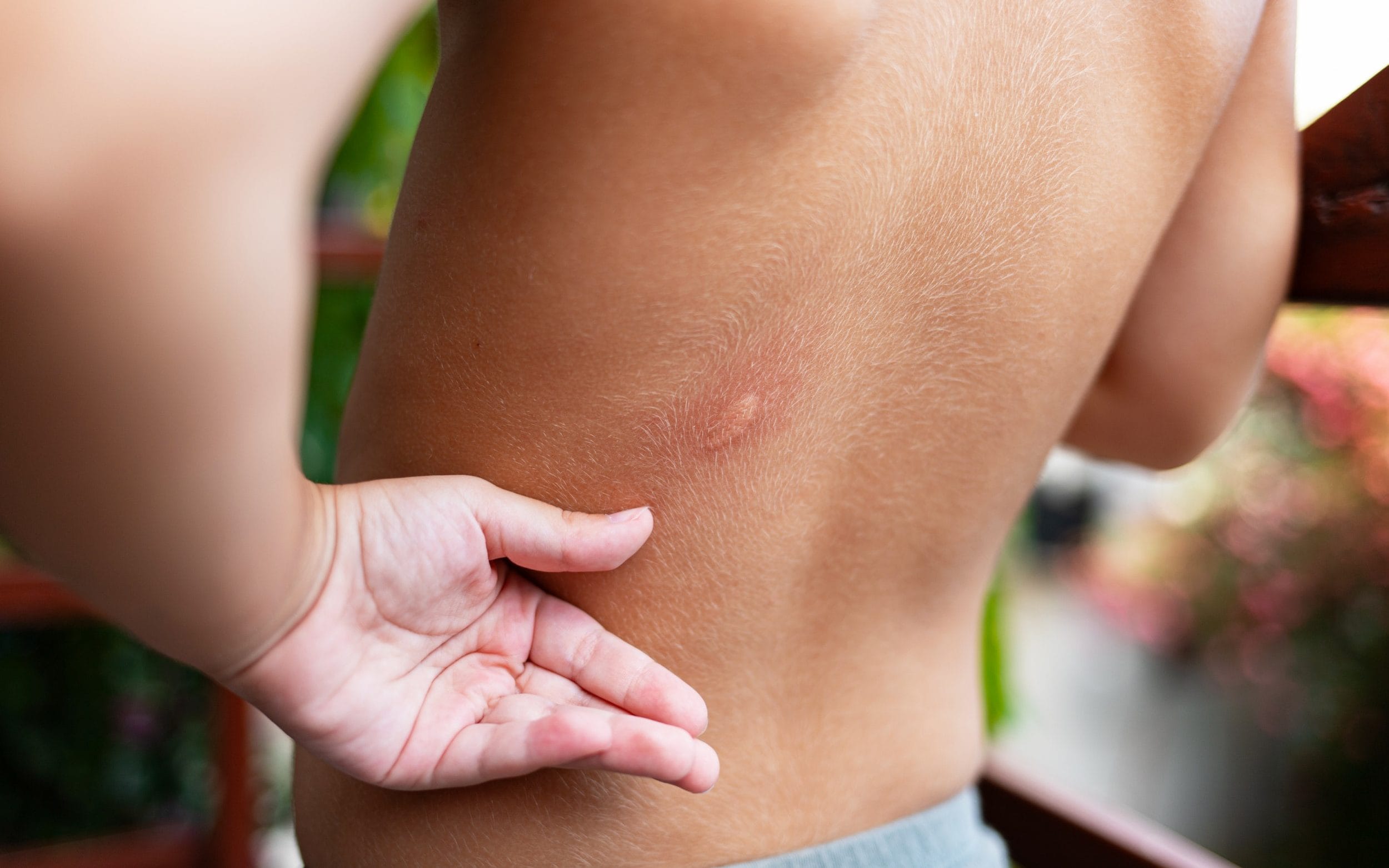 Zika, chikungunya and dengue fever are all spread by mosquito bites