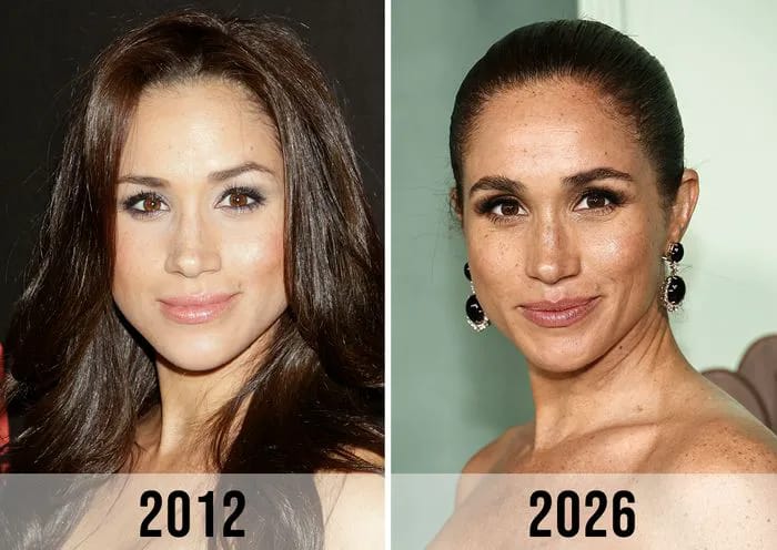 Plastic Surgeon Breaks Down Meghan Markle's Transformation