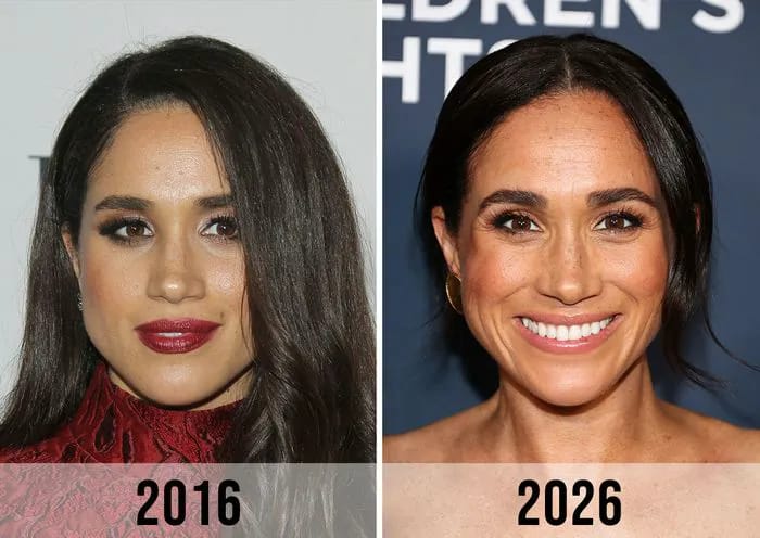 Plastic Surgeon Breaks Down Meghan Markle's Transformation