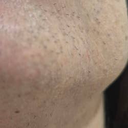 Close-up of skin with visible hair stubble on the chin area