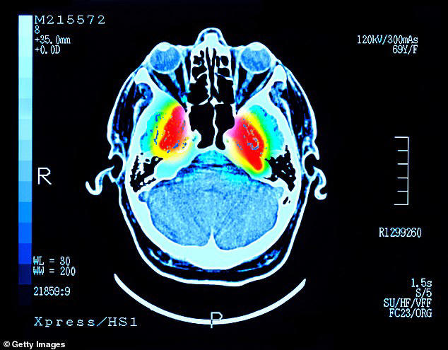 People with advanced Alzheimer's disease have occasionally been reported to suddenly recognize loved ones, recall long–forgotten memories and hold coherent conversations shortly before death in a phenomenon known as terminal lucidity