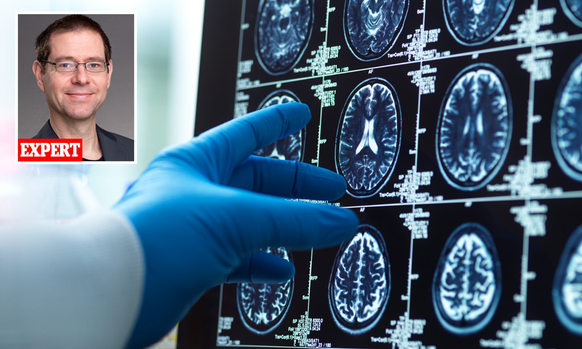 Why some dementia patients regain their memory shortly before death