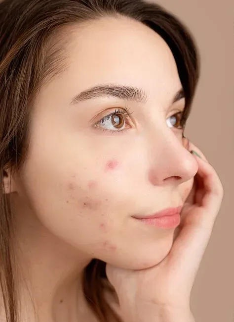 5. Skin breakouts or flare ups that seem to follow certain meals (Image Credits: Pexels)