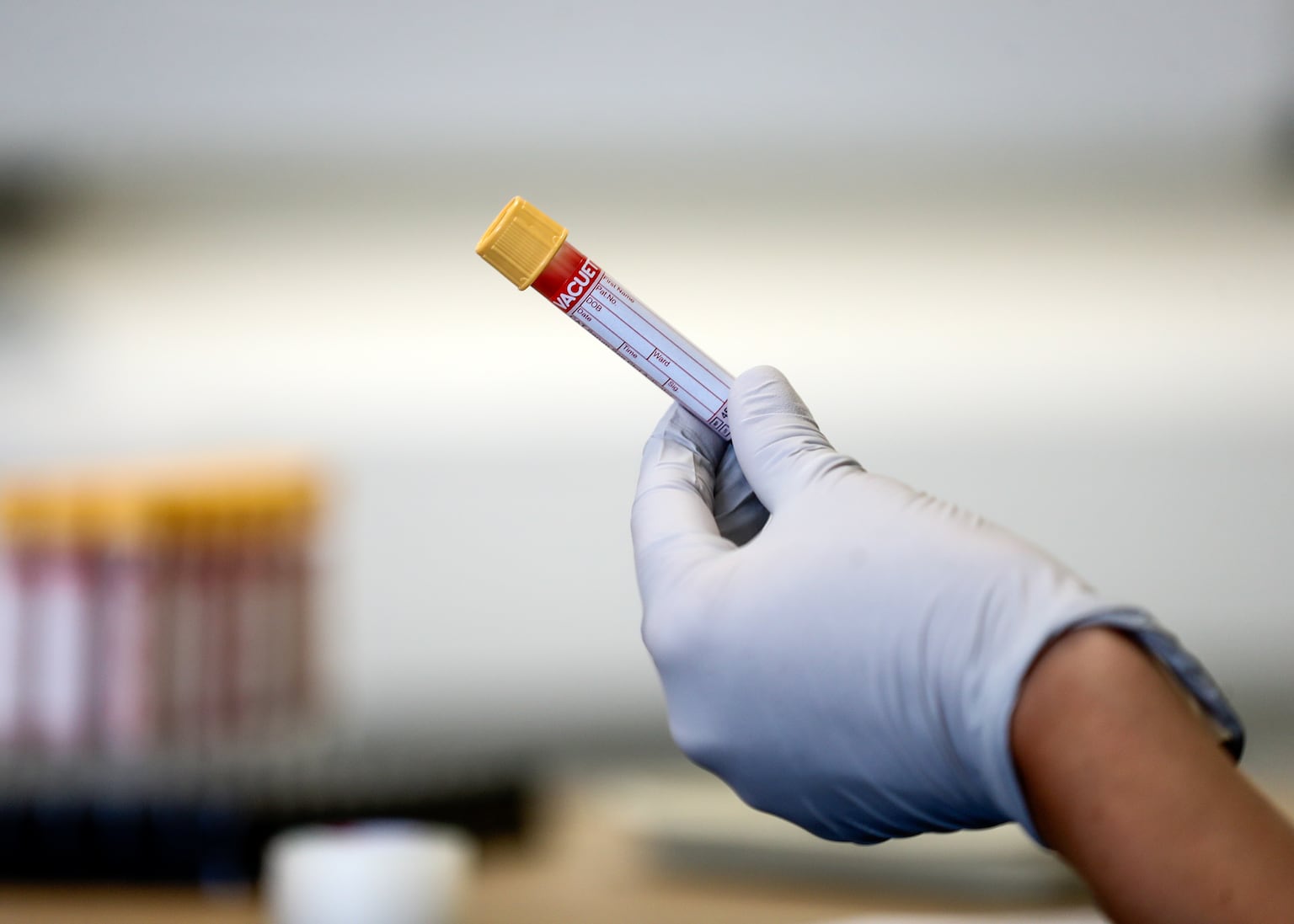 Blood test could detect autoimmune disorder 10 years before symptoms – study