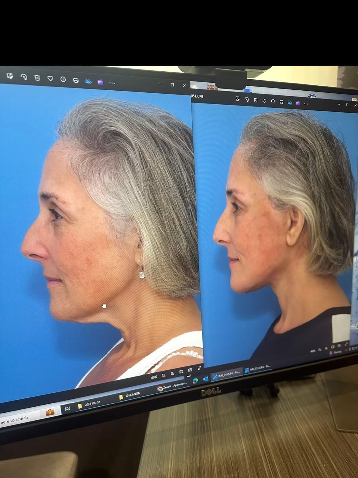 Ricki Lake Shares Before-and-After Facelift Photos, Says She ‘Took a Leap of Faith’