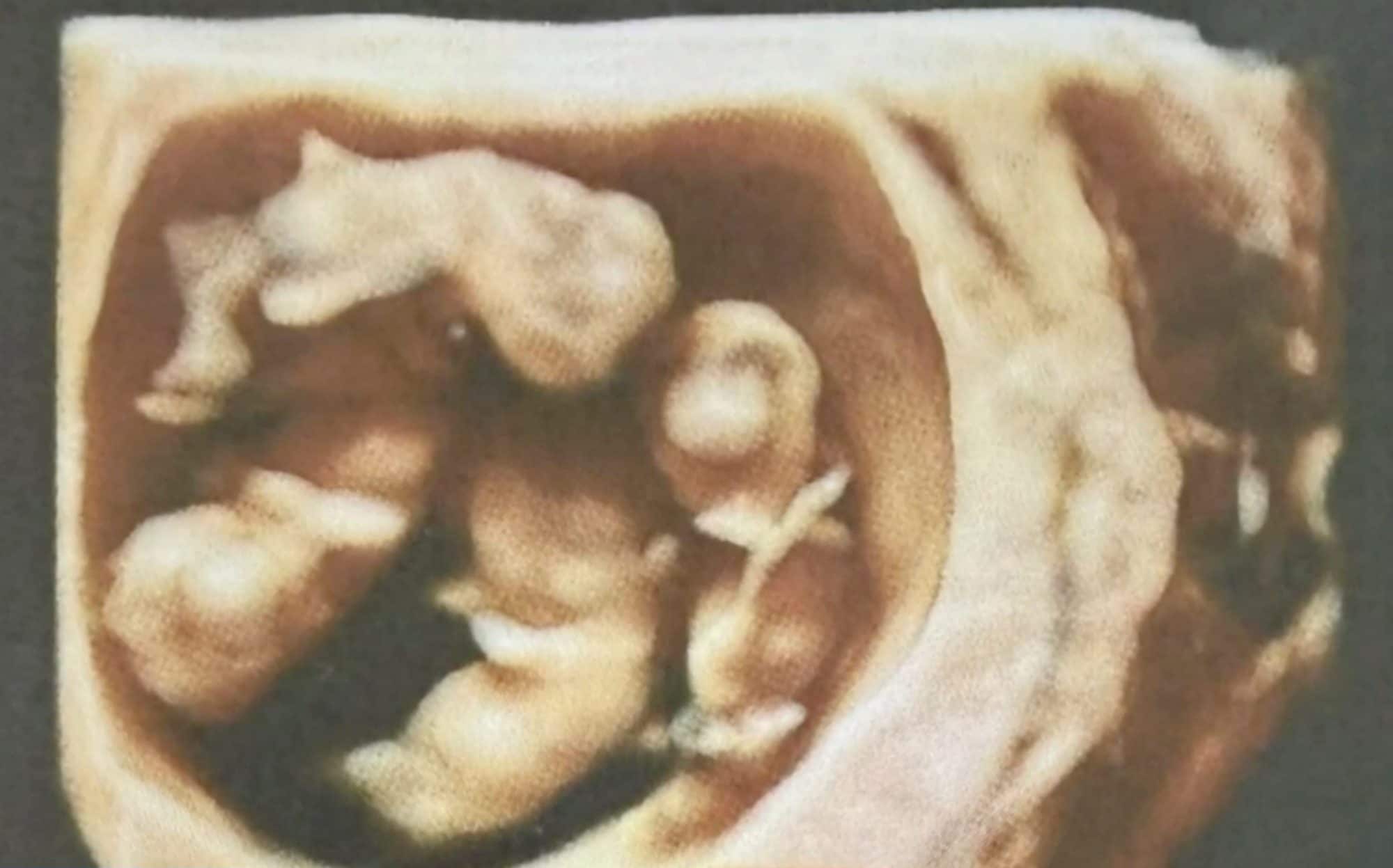 An ultrasound of the quadruplets, who were born at the Royal Brisbane and Women's Hospital