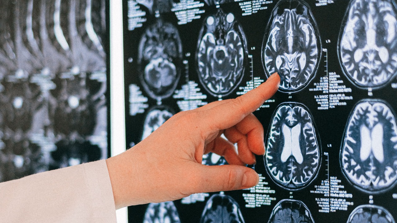 Radiation exposure may flip a switch that helps trigger Alzheimer’s ...