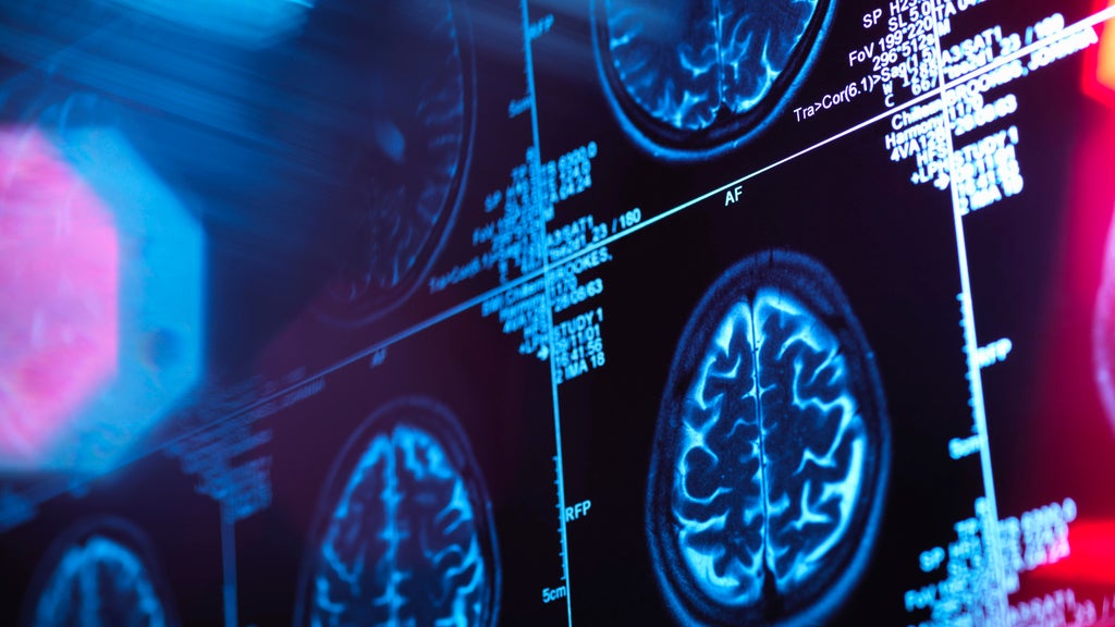 Piedmont Atlanta expands Gamma Knife radiosurgery program for brain tumors and neurological conditions