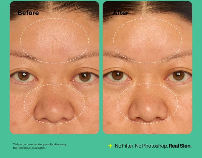 Comparison image of a person's forehead, eyes, and nose before and after using Snail Rescue Collection, highlighting skin improvements in 14 days
