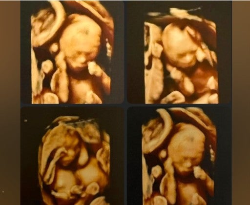 Dr Alexa Bendall, who oversaw Na’amoana’s care, said she had never encountered such a pregnancy before (GoFundMe)