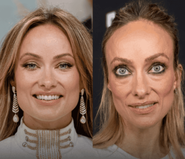 Ozempic? A aparência chocante de celebridades que emagreceram rapidamente
