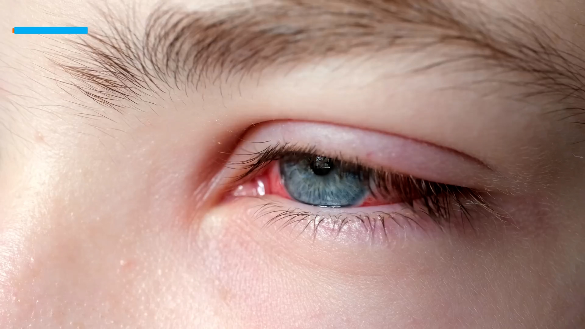 Why is your eye suddenly bloody? Doctors explain hyphema and treatment