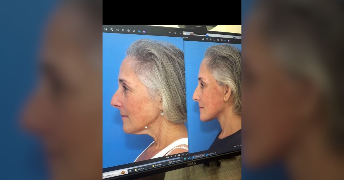 Ricki Lake shares unfiltered before-and-after facelift photos