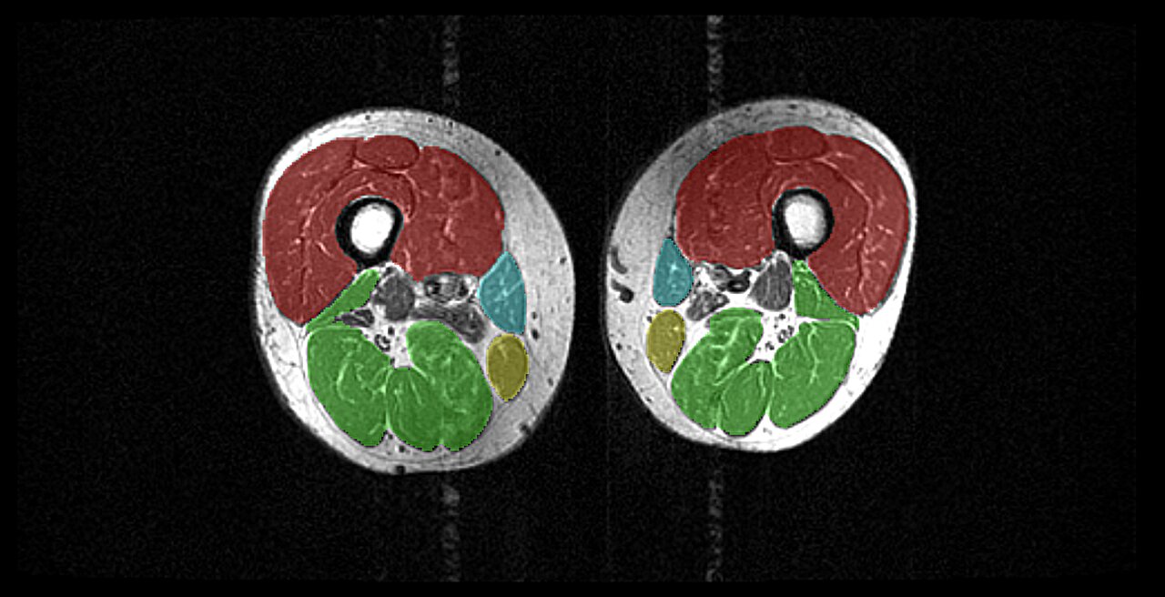 It's not just fat: Yo-yo dieting might mean losing muscle, too