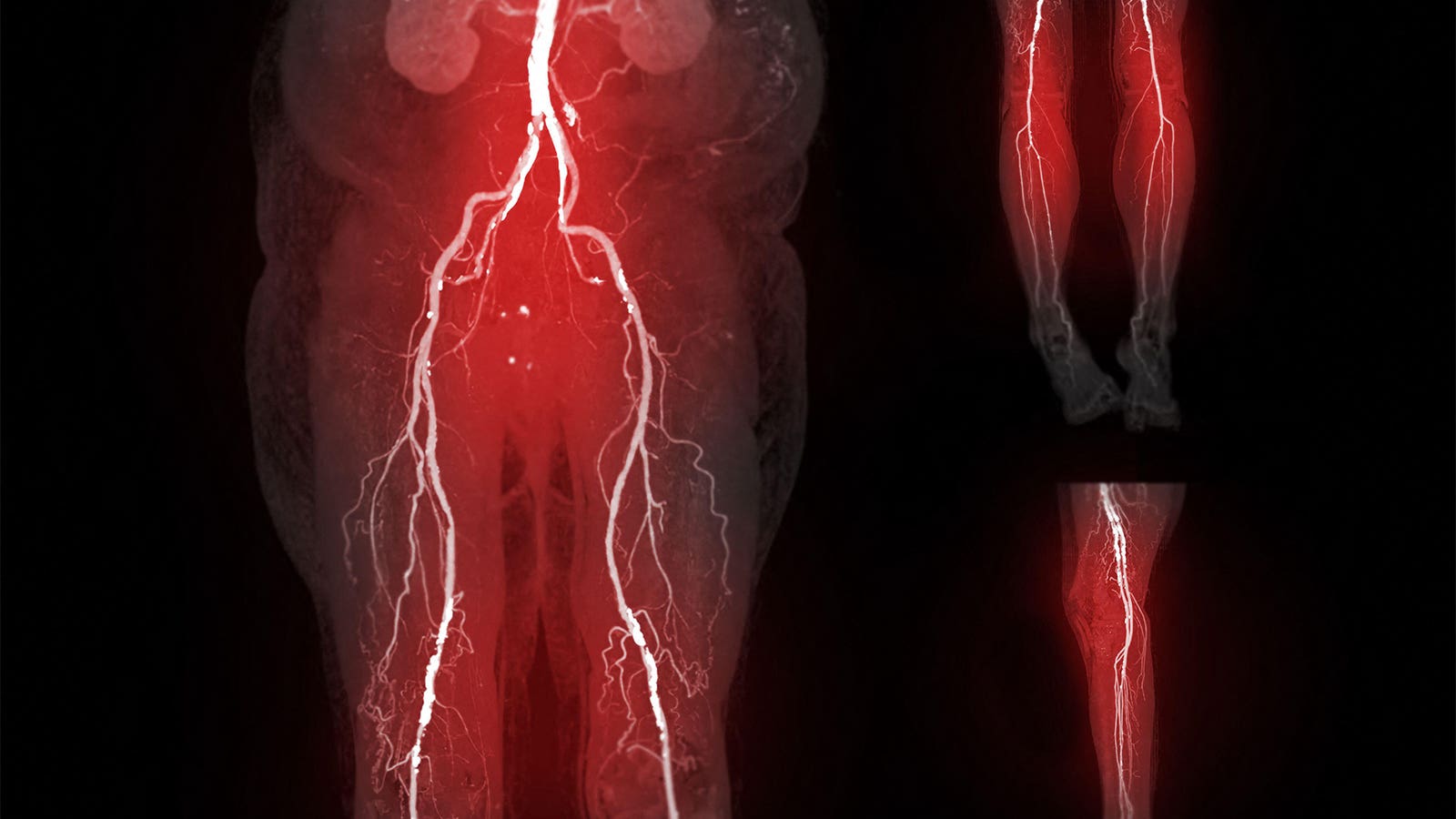 Pregnancy complications linked to risk of peripheral artery disease
