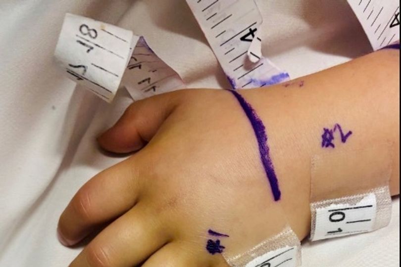 Addy, was bitten by the venomous snake