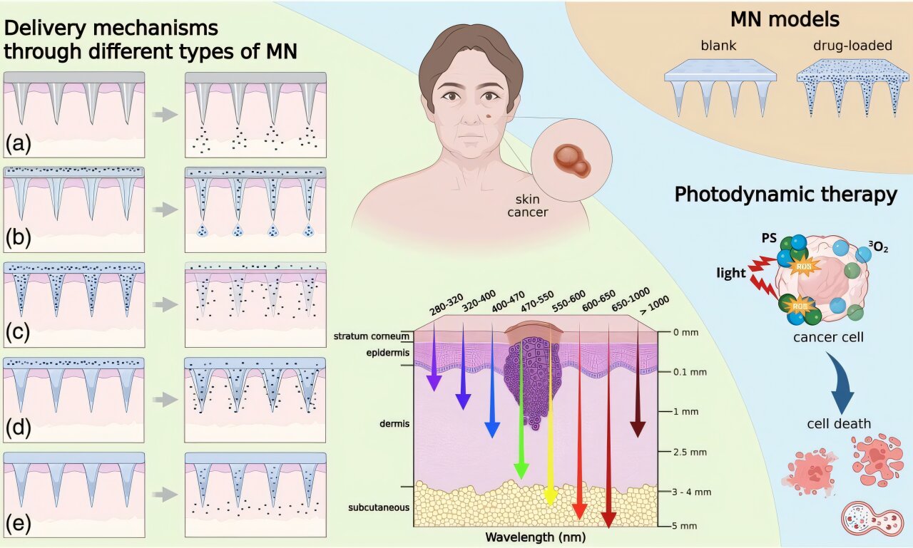 Microneedles may help light reach hard-to-treat skin cancers
