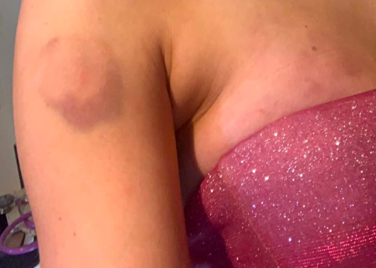 Clíodhna was left with bruises and bite marks after her ordeal at the hands of Eoin McKervey