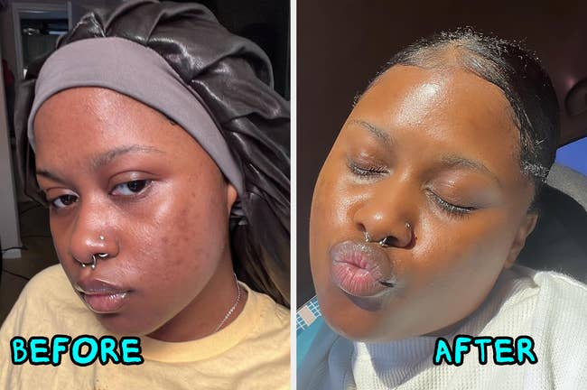 Before and after images of a person's skin treatment, showing improvement from textured skin to smooth, glowing skin