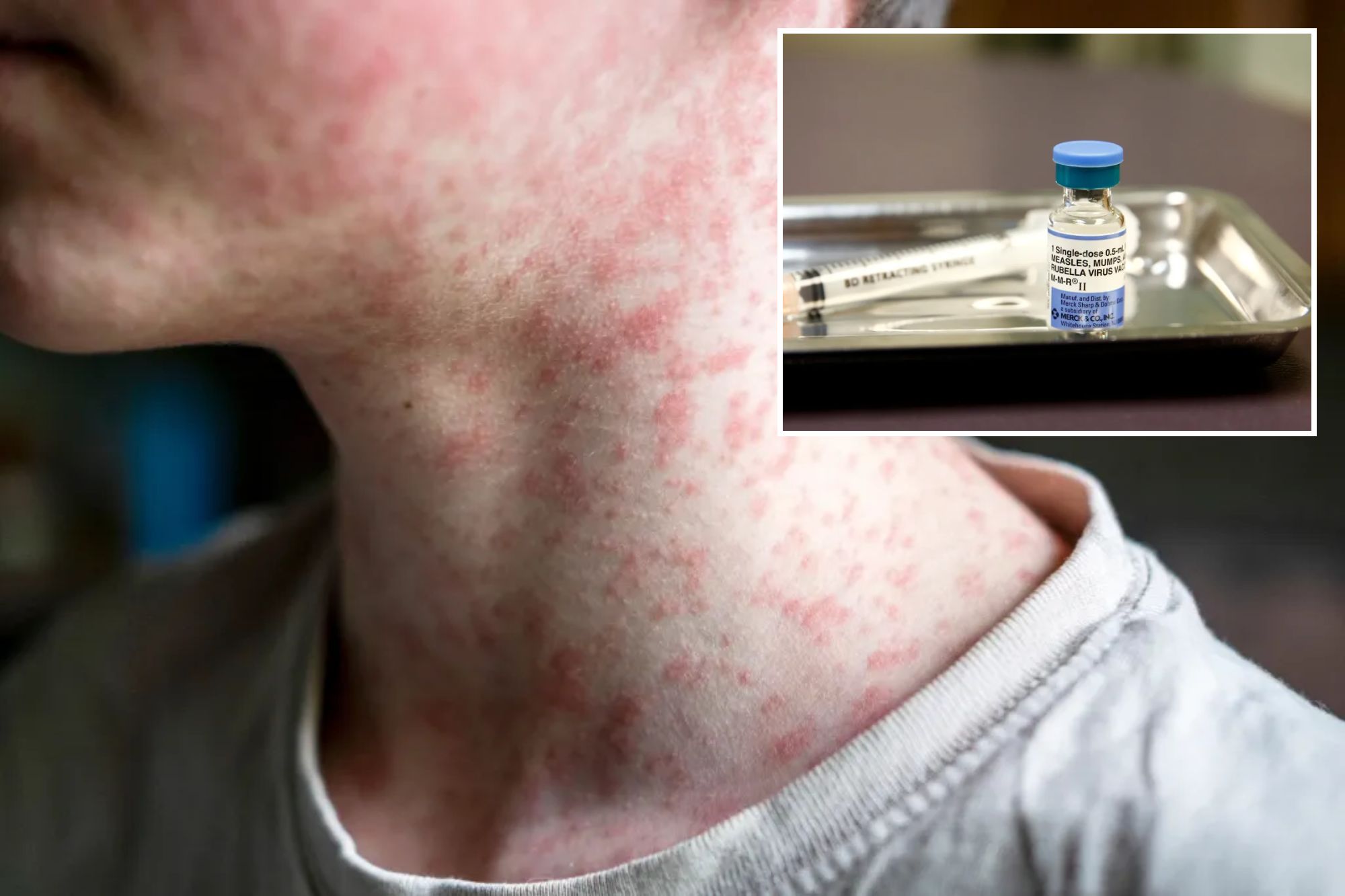 US hits most cases of 'world's most contagious disease' in 35 years — and it's only July