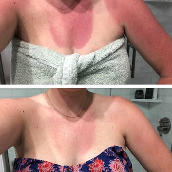 Two images showing a reviewer's chest and shoulders: one with a visible sunburn and towel, the other with faded burn and a floral outfit