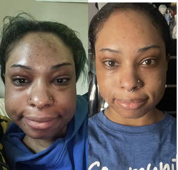 Side-by-side comparison of a woman's face showing a skincare transformation, with smoother, clearer skin on the right