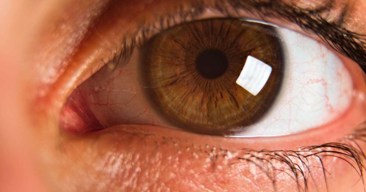 Woman's Eye Sewn Shut After Parasite Ate Her Cornea She Didn't Remove Her Contacts After Falling. A Parasite Ate Her Cornea.