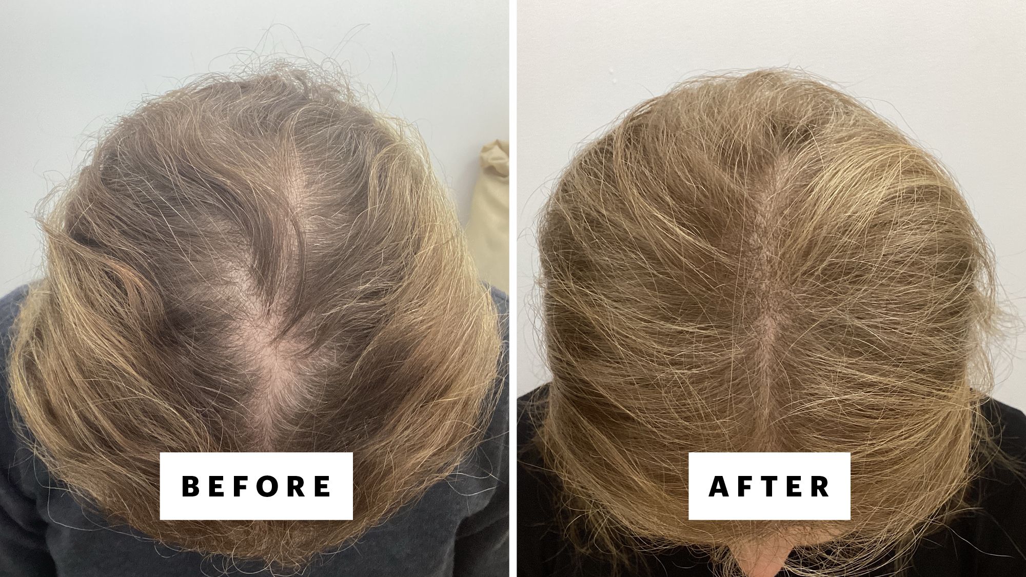 A patient of Dr. Robert Finney, before and 20 months after starting oral minoxidil and doing six ScalpStim treatments.