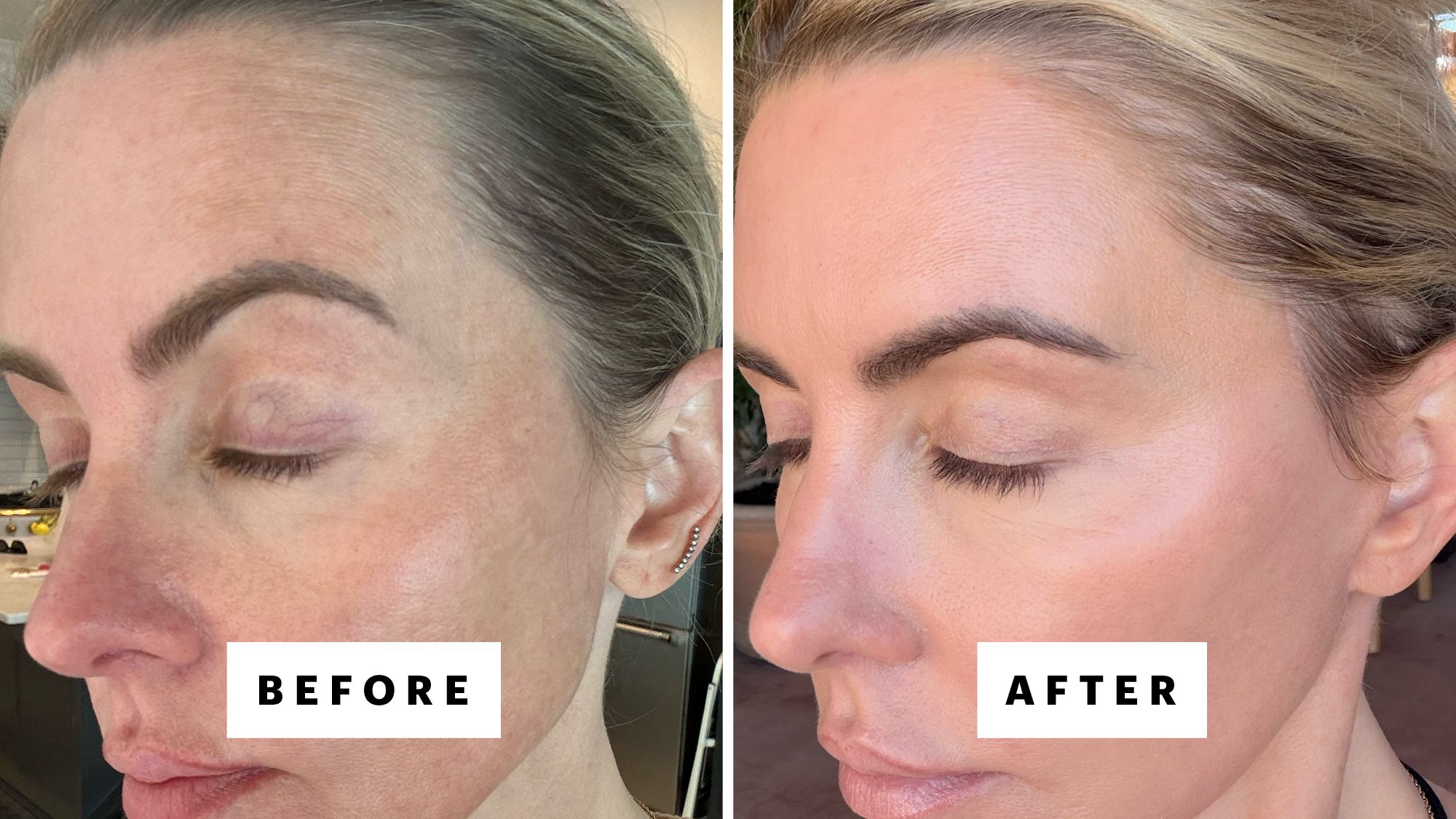 Melissa Coleman, or @mrs.derm, before and nine months after starting oral minoxidil. (She is doing no other hair loss treatment.)