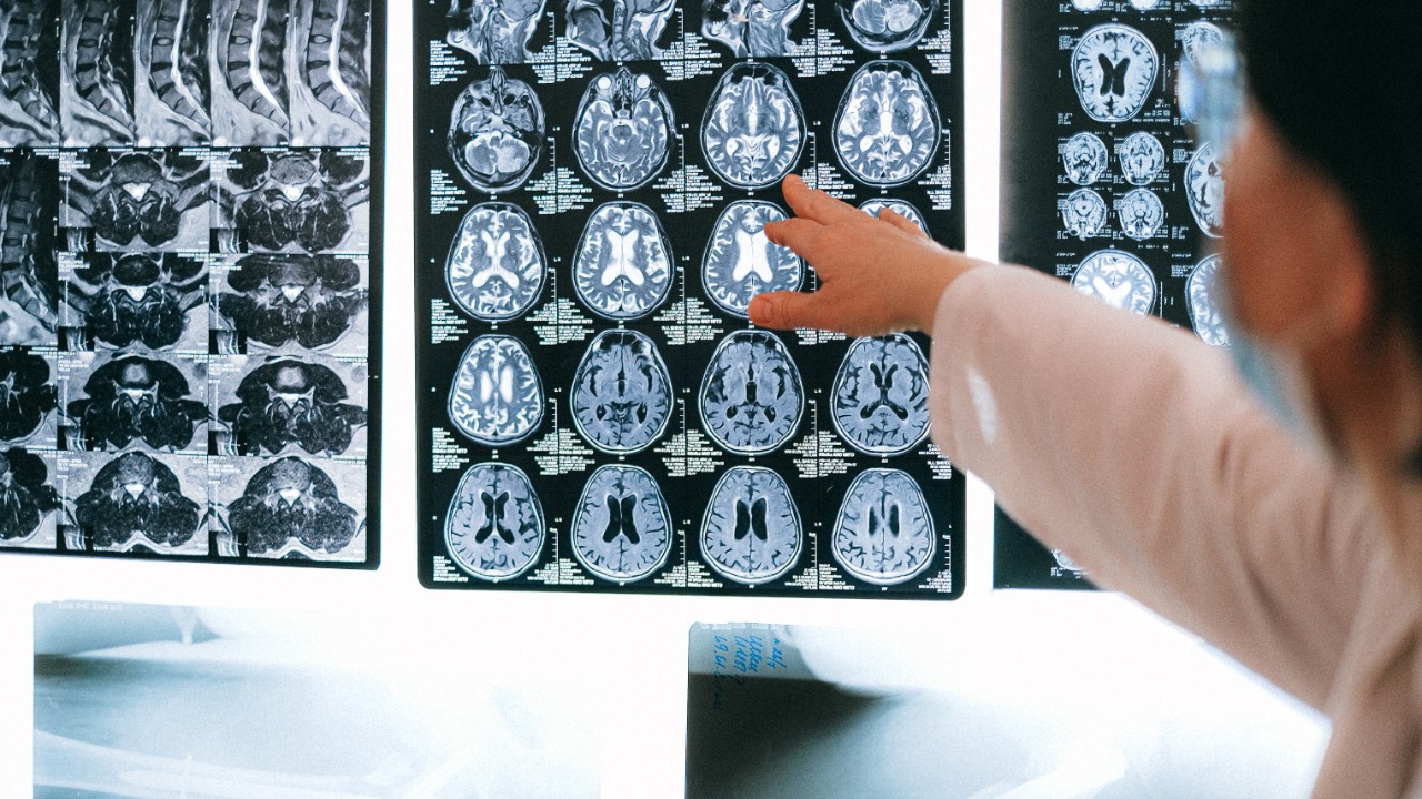 Microplastics are collecting in human brains at levels far higher than in the liver or kidneys