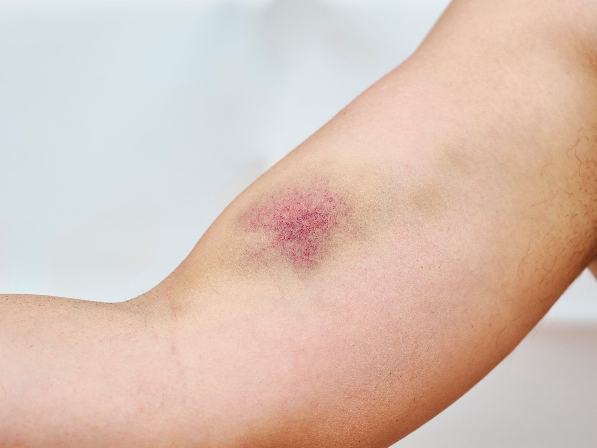 A close-up of a person's arm displaying a bruise