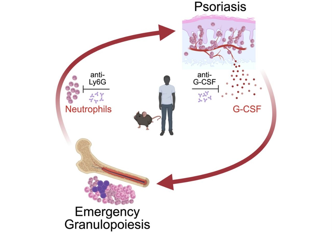 Skin-bone marrow axis discovery opens new doors for psoriasis treatment