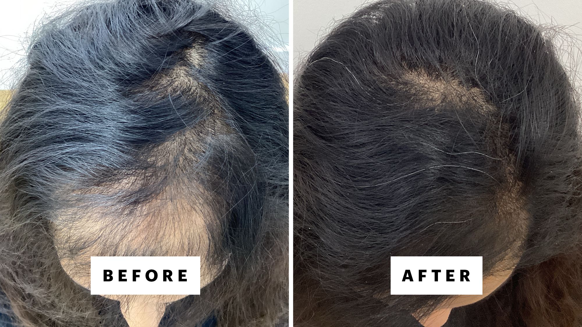 A patient of Dr. Robert Finney before and 16 months after starting oral minoxidil plus five ScalpStim treatments (dutasteride and growth factors delivered to the scalp through microneedling and ultrasound).