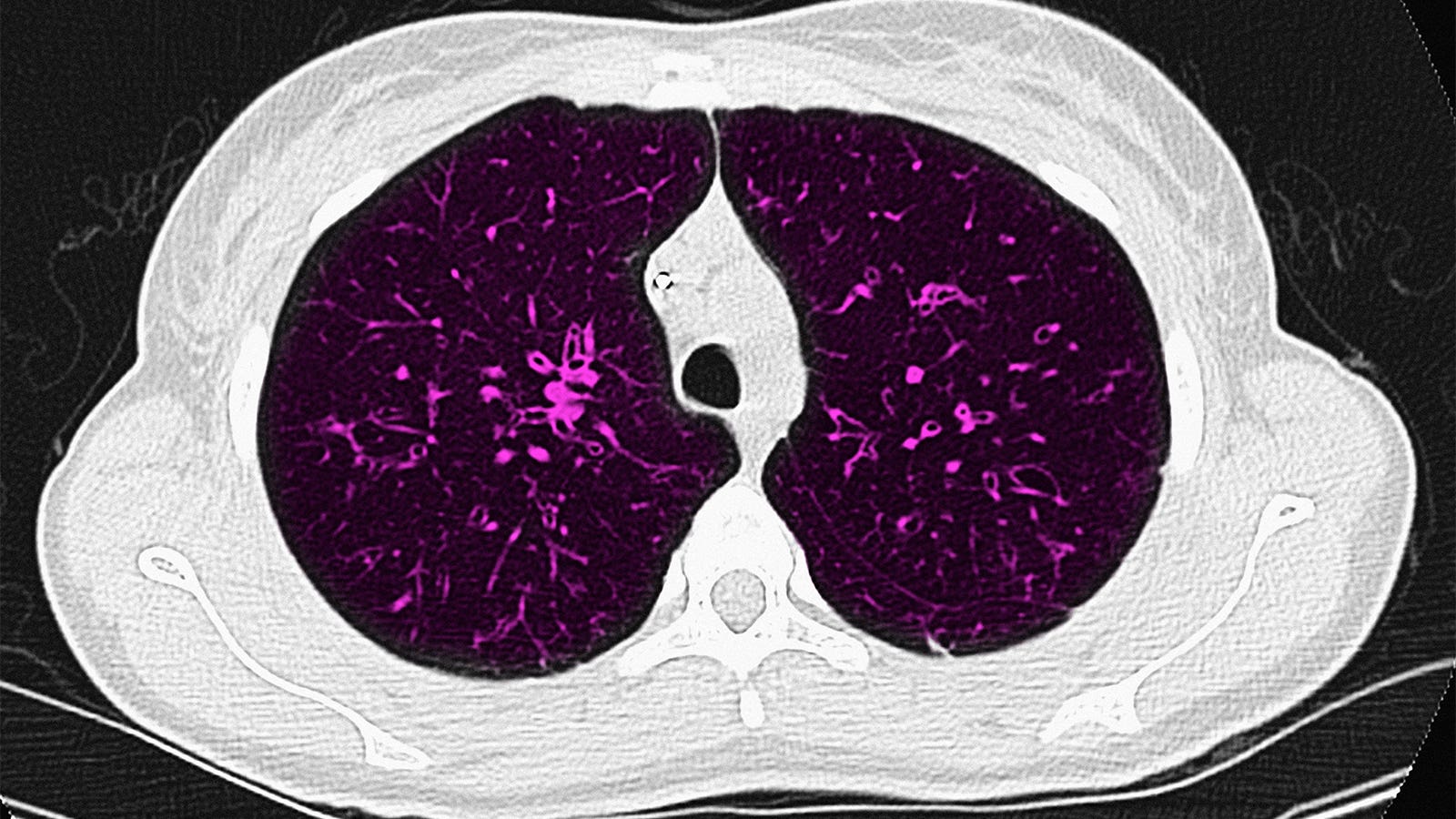 Reproductive health should be emphasized in cystic fibrosis care, foundation says