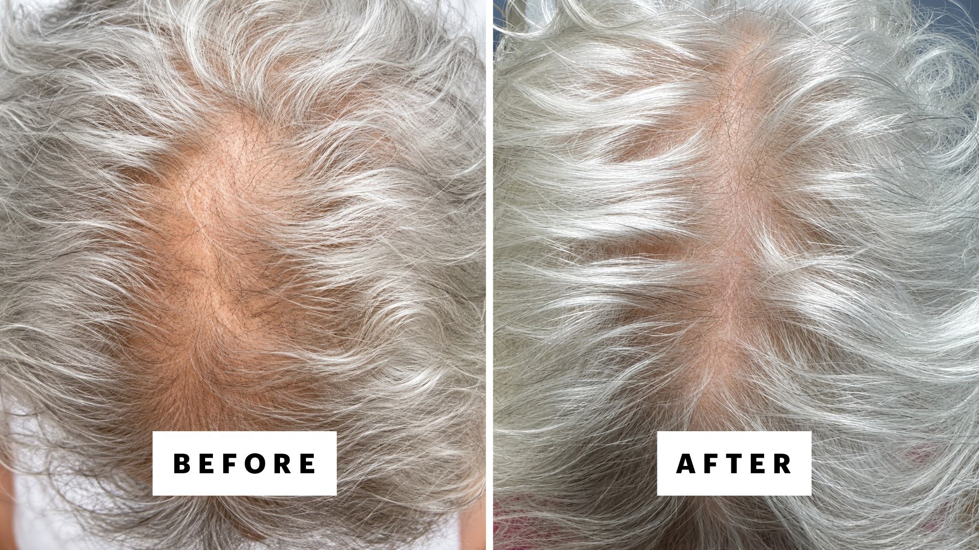 A patient of Dr. Oma Agbai before and after 10 months on oral minoxidil. (She was using no other hair loss treatments.)