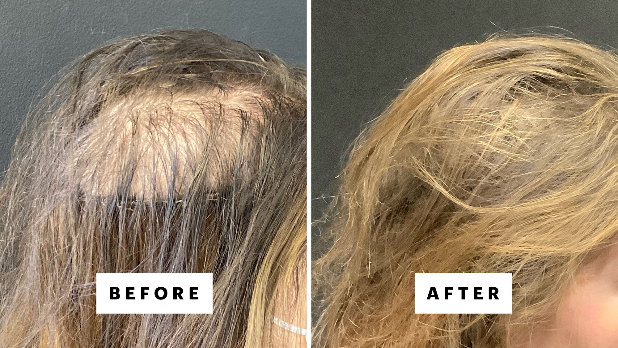 A patient of Dr. Amelia Hausauer before and five years after starting oral minoxidil. This patient also did three monthly PRP treatments, with a maintenance session once every four months. (Full results were seen after 12 months and have been maintained with oral minoxidil and thrice yearly PRP.)