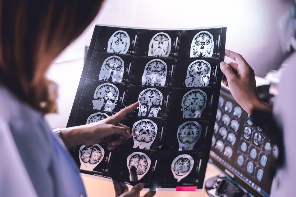 Your husband (or wife) may increase your risk of dementia by up to 70%