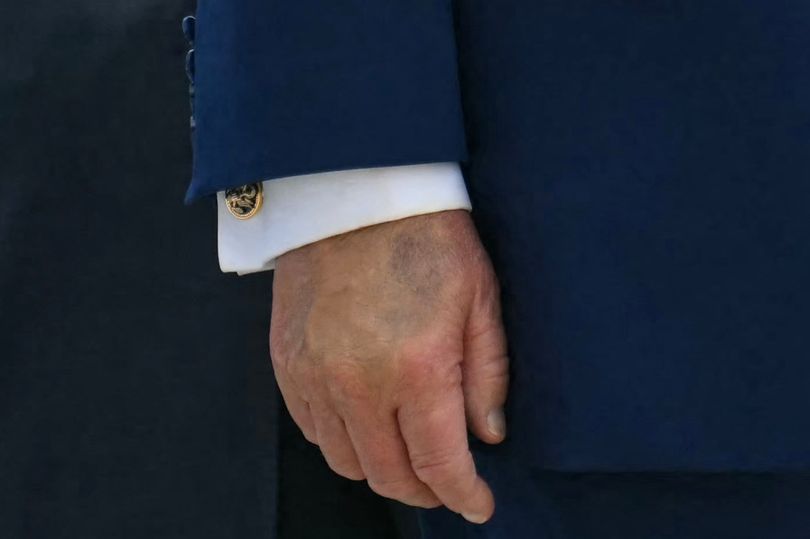 Trump's bruised hands fuel health 'cover up' worries as president continues to try to conceal marks