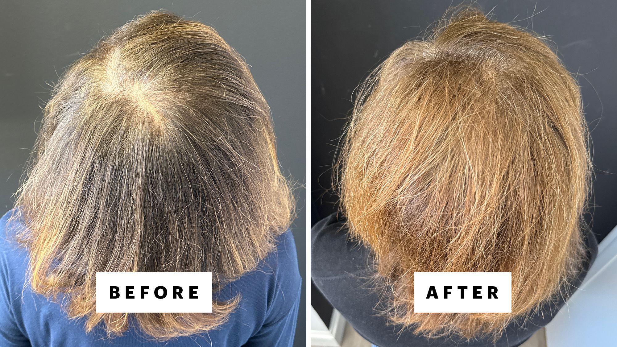 A patient of Dr. Amelia Hausauer before and 20 months after starting oral minoxidil. This patient also did three monthly PRP treatments, and now does a maintenance session once every six months. (Many people taking oral minoxidil are also pursuing at least one other hair loss treatment, at least initially, to both expedite and maximize their results.)