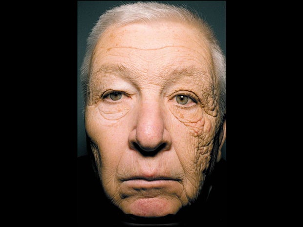 The 69-year-old man who drove a delivery truck for 28 years shows damaged skin on the left side of his face. Credit: New England Journal of Medicine