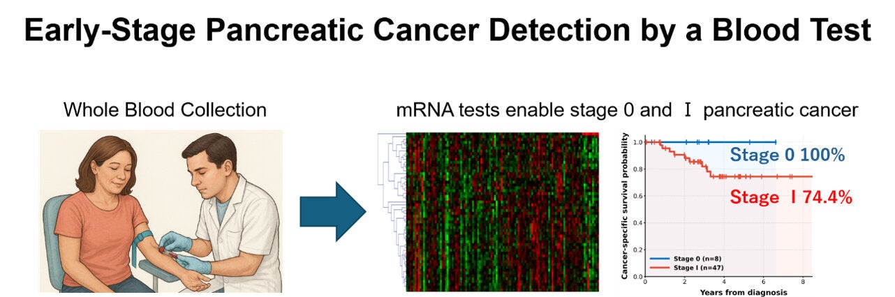A simple blood test may help detect pancreatic cancer at its earliest stages, including Stage 0 disease, when treatment offers the best chance of survival. (CREDIT: Kanazawa University