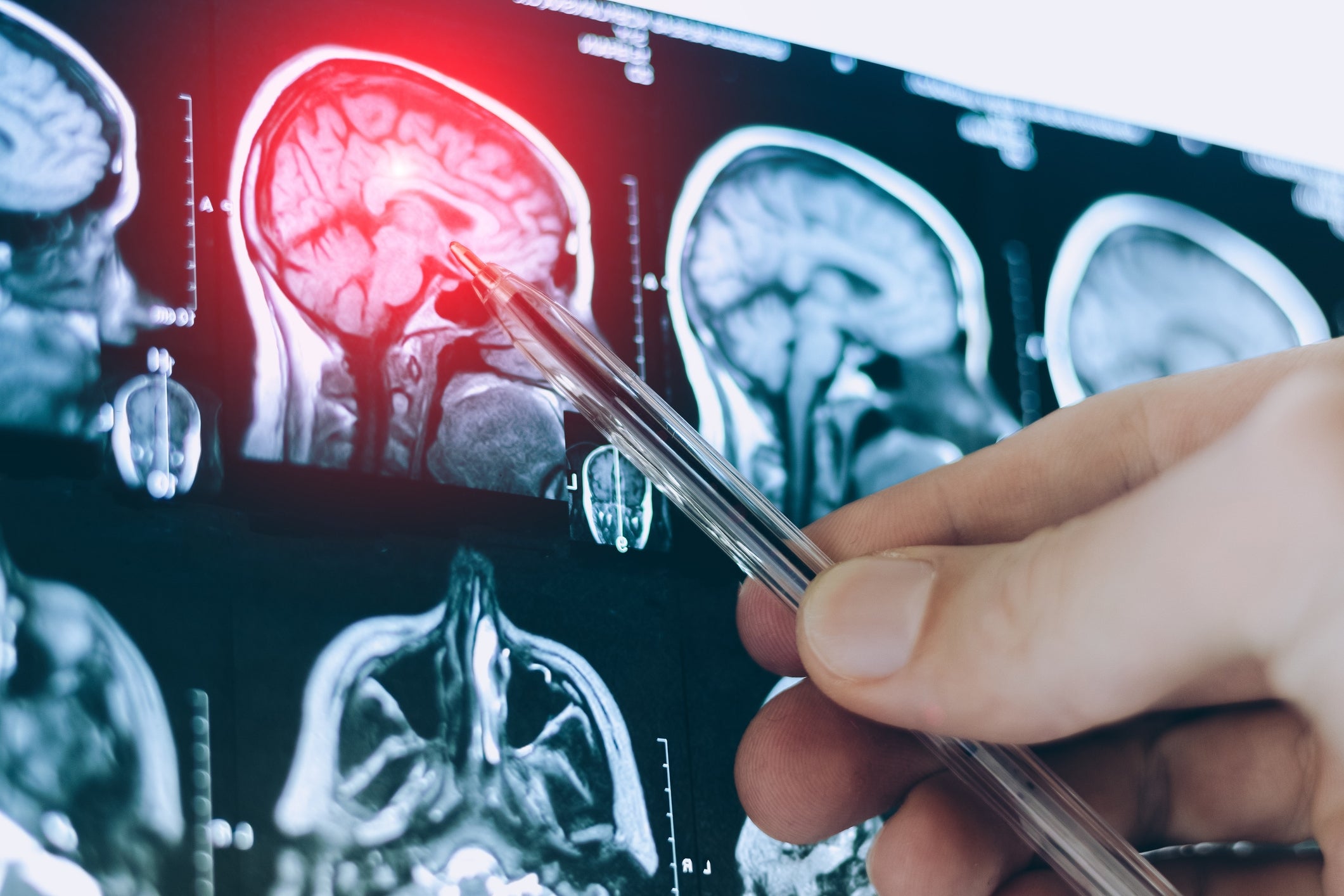 Medical professional pointing at a brain scan with a pen, highlighting an area of interest in the brain