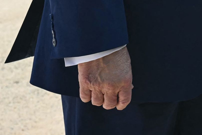 Trump's multicolored hand bruise sparks further health concerns
