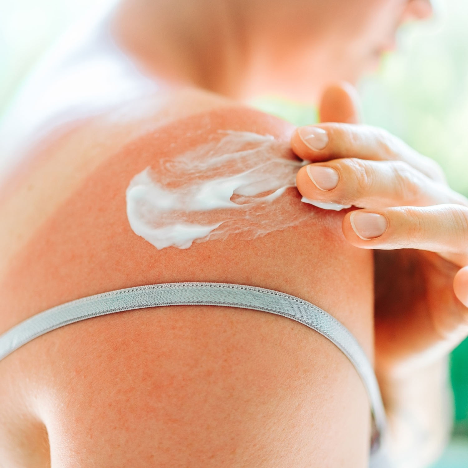 The best ways to avoid (and treat) heat rash and sun poisoning, according to derms