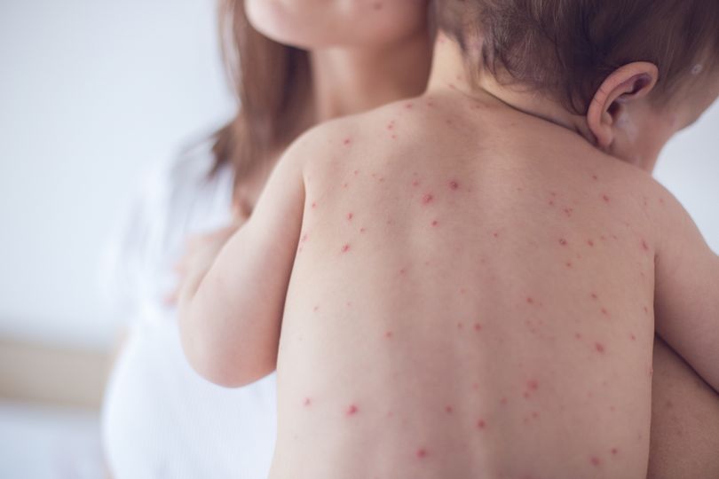 Measles was eliminated in 2000 after the rollout of the MMR vaccine