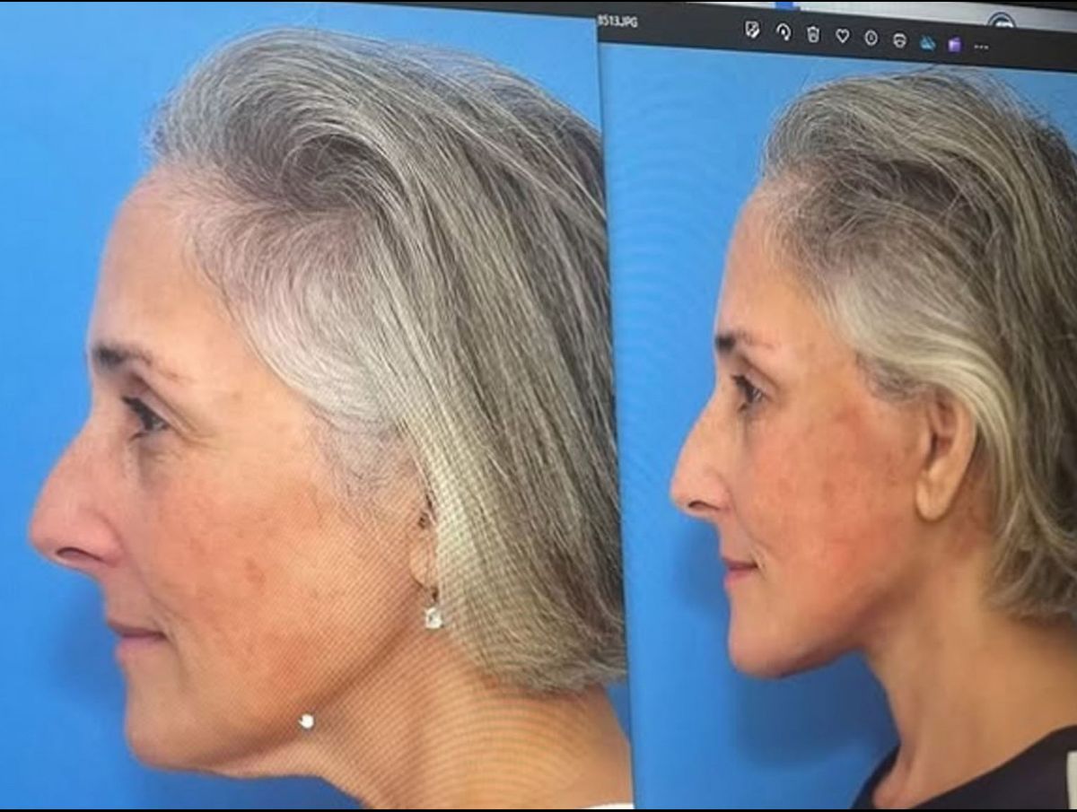 Ricki Lake has shared before-and-after photos from her facelift