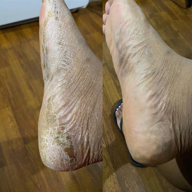 Before image of a cracked and dry heel; After image of the same heel now smooth