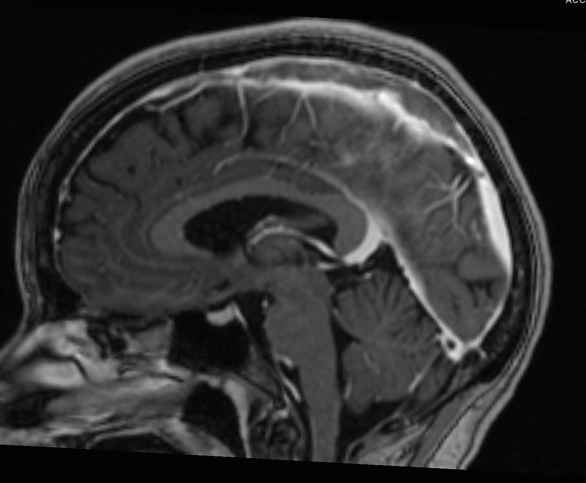 MRI scan showing a side view of a human brain, detailing its internal structures and contours